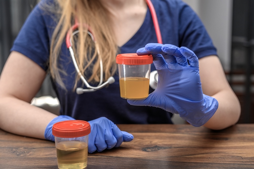 Lab technician holding a urine plastic container for klonopin drug test